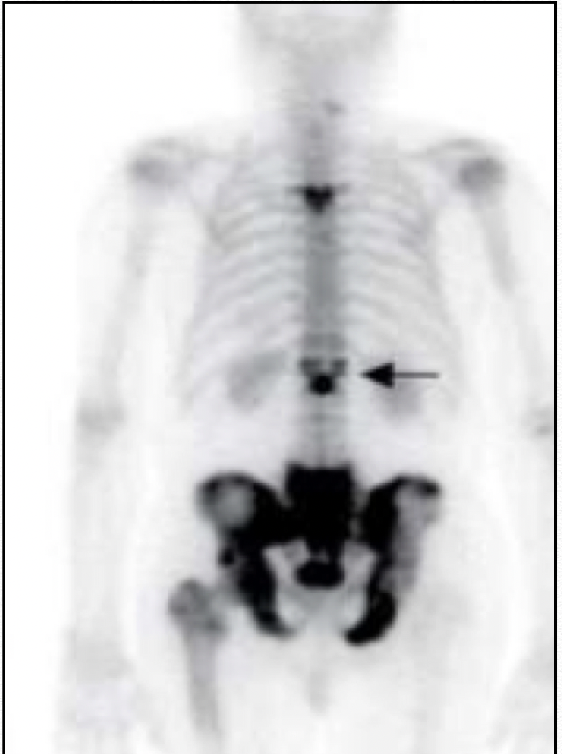 Pagets Disease On Bone Scan Nuc Med Clinics